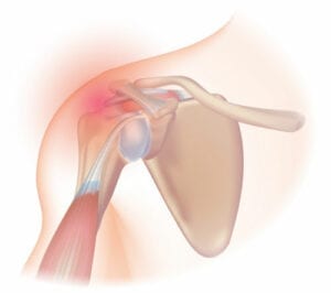 Frozen Shoulder is Unlocked with Bodywork - Dreamclinic Massage Seattle