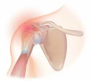 frozen shoulder